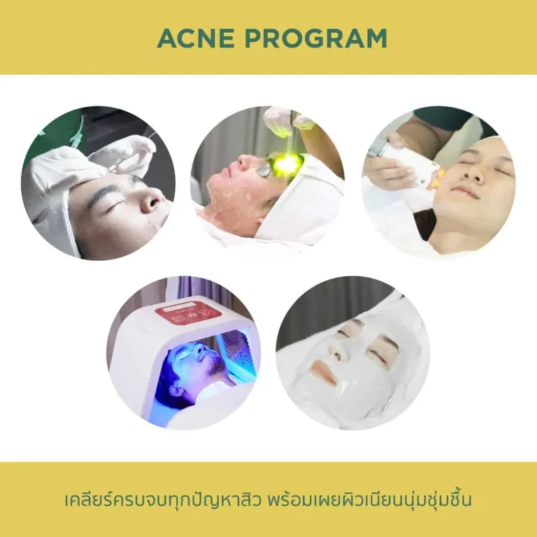 Acne Program โปรแกรมดูแลปัญหาสิวและรอยสิว Acne Program โปรแกรมรักษาสิวที่ออกแบบตามสภาพผิว Acne Program สำหรับดูแลสิวอุดตัน สิวอักเสบ และรอยสิว โปรแกรมรักษาสิว Acne Program โดยแพทย์ประเมินเฉพาะบุคคล Acne Program ตัวช่วยดูแลปัญหาสิวและผิวมัน Acne Program โปรแกรมดูแลผิวที่มีปัญหาสิวเรื้อรัง Acne Program สำหรับผู้ที่กังวลเรื่องสิวอักเสบและสิวขึ้นซ้ำ Acne Program ดูแลปัญหาสิวบนใบหน้าอย่างเหมาะกับแต่ละคน Acne Program โปรแกรมดูแลสิวสำหรับผิวที่เป็นสิวง่าย Acne Program ช่วยดูแลสิวอุดตัน รอยแดง และรอยสิว