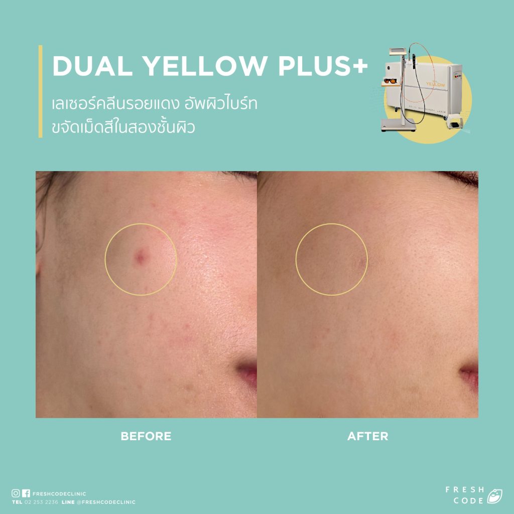 Dual Yellow Plus before after ลดรอยแดงสิว เลเซอร์รักษาสิวและรอยแดง ช่วยให้ผิวเรียบเนียนขึ้น ที่ Fresh Code Clinic
