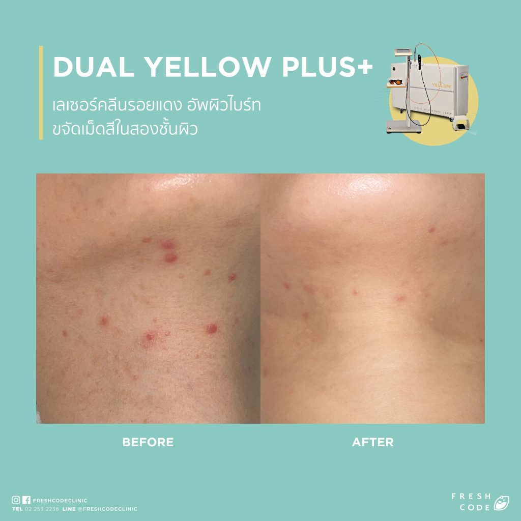 Dual Yellow Plus before after ลดรอยแดงสิว เลเซอร์รักษาสิวและรอยแดง ช่วยให้ผิวเรียบเนียนขึ้น ที่ Fresh Code Clinic