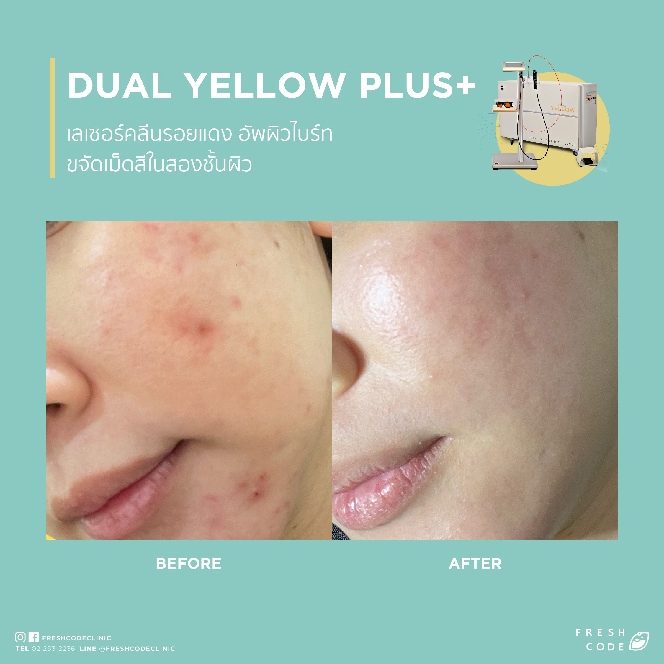 Dual Yellow Plus before after ลดรอยแดงสิว เลเซอร์รักษาสิวและรอยแดง ช่วยให้ผิวเรียบเนียนขึ้น ที่ Fresh Code Clinic