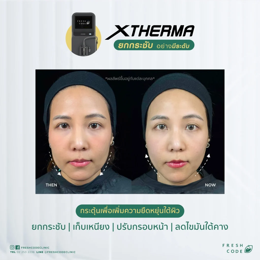 Before After XTherma skin tightening treatment ช่วยยกกระชับกรอบหน้า ลดเหนียง และกระตุ้นคอลลาเจนใต้ผิว โดยแพทย์ที่ Fresh Code Clinic กรุงเทพ
