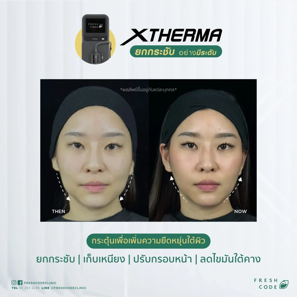 Before After XTherma skin tightening treatment ช่วยยกกระชับกรอบหน้า ลดเหนียง และกระตุ้นคอลลาเจนใต้ผิว โดยแพทย์ที่ Fresh Code Clinic กรุงเทพ