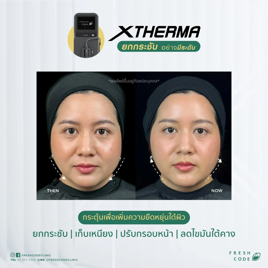Before After XTherma skin tightening treatment ช่วยยกกระชับกรอบหน้า ลดเหนียง และกระตุ้นคอลลาเจนใต้ผิว โดยแพทย์ที่ Fresh Code Clinic กรุงเทพ
