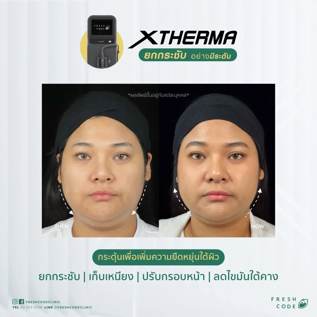 Before After XTherma skin tightening treatment ช่วยยกกระชับกรอบหน้า ลดเหนียง และกระตุ้นคอลลาเจนใต้ผิว โดยแพทย์ที่ Fresh Code Clinic กรุงเทพ