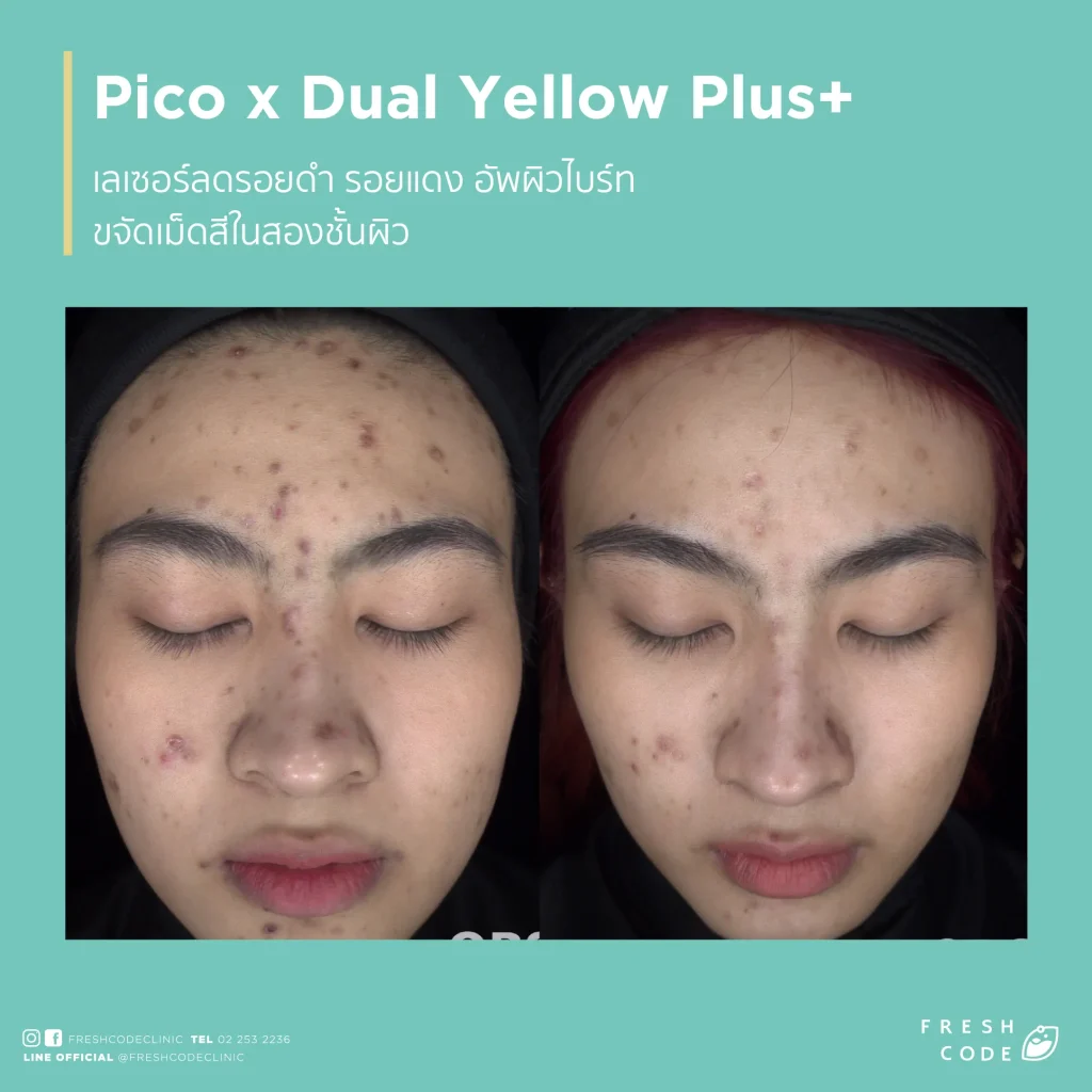 Pico Discovery before and after ลดรอยดำ รอยสิว และปรับสีผิวให้ดูสม่ำเสมอ