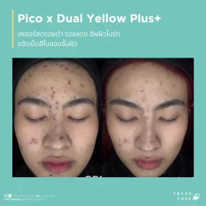 Pico Discovery before and after ลดรอยดำ รอยสิว และปรับสีผิวให้ดูสม่ำเสมอ