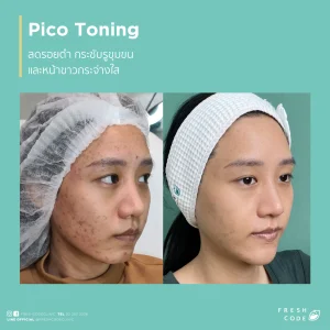 Pico Discovery before and after ลดรอยดำ รอยสิว และปรับสีผิวให้ดูสม่ำเสมอ