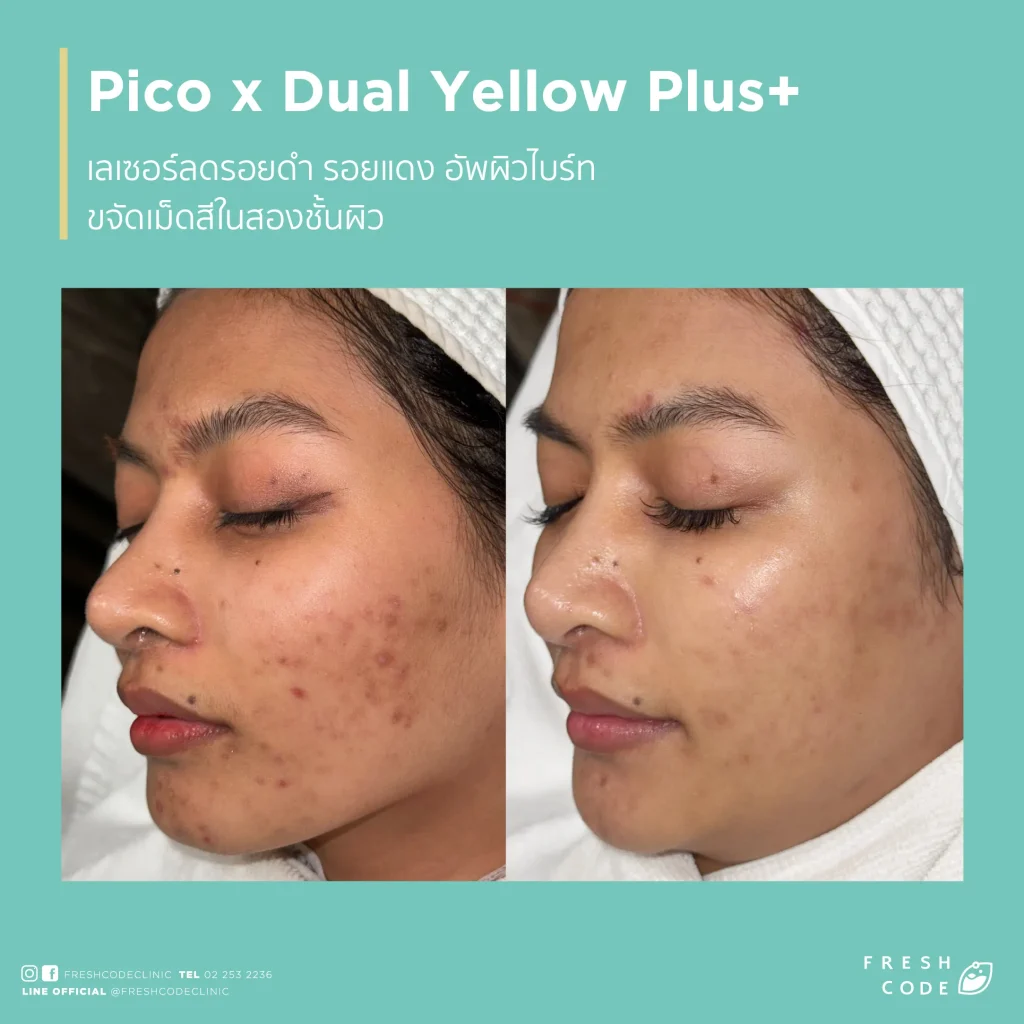 Pico Discovery before and after ลดรอยดำ รอยสิว และปรับสีผิวให้ดูสม่ำเสมอ