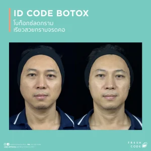ผลลัพธ์ก่อนและหลังฉีด Botox เพื่อลดริ้วรอยและปรับกรอบหน้า Before after Botox สำหรับลดริ้วรอยหน้าผาก หว่างคิ้ว และหางตา ภาพก่อนและหลังฉีด Botox เพื่อให้ใบหน้าดูเรียบเนียนขึ้น Botox before after สำหรับลดริ้วรอยและทำให้กรอบหน้าดูคมขึ้น ผลลัพธ์ก่อนหลัง Botox สำหรับผู้ที่กังวลเรื่องริ้วรอยและรูปหน้า Botox before and after for smoother-looking skin and a more defined jawline Before and after Botox for forehead lines,frown lines,and crow’s feet Botox before and after results for facial lines and a softer appearance Before and after Botox for wrinkle reduction and facial contour refinement Botox before and after for a smoother,more refreshed look
