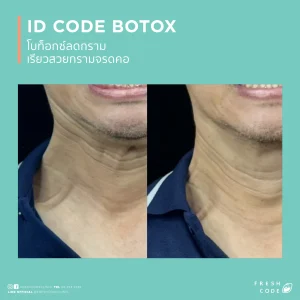 ผลลัพธ์ก่อนและหลังฉีด Botox เพื่อลดริ้วรอยและปรับกรอบหน้า Before after Botox สำหรับลดริ้วรอยหน้าผาก หว่างคิ้ว และหางตา ภาพก่อนและหลังฉีด Botox เพื่อให้ใบหน้าดูเรียบเนียนขึ้น Botox before after สำหรับลดริ้วรอยและทำให้กรอบหน้าดูคมขึ้น ผลลัพธ์ก่อนหลัง Botox สำหรับผู้ที่กังวลเรื่องริ้วรอยและรูปหน้า Botox before and after for smoother-looking skin and a more defined jawline Before and after Botox for forehead lines,frown lines,and crow’s feet Botox before and after results for facial lines and a softer appearance Before and after Botox for wrinkle reduction and facial contour refinement Botox before and after for a smoother,more refreshed look