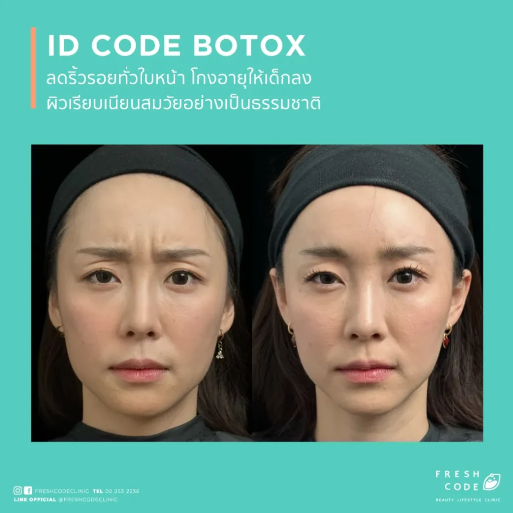 ผลลัพธ์ก่อนและหลังฉีด Botox เพื่อลดริ้วรอยและปรับกรอบหน้า Before after Botox สำหรับลดริ้วรอยหน้าผาก หว่างคิ้ว และหางตา ภาพก่อนและหลังฉีด Botox เพื่อให้ใบหน้าดูเรียบเนียนขึ้น Botox before after สำหรับลดริ้วรอยและทำให้กรอบหน้าดูคมขึ้น ผลลัพธ์ก่อนหลัง Botox สำหรับผู้ที่กังวลเรื่องริ้วรอยและรูปหน้า Botox before and after for smoother-looking skin and a more defined jawline Before and after Botox for forehead lines,frown lines,and crow’s feet Botox before and after results for facial lines and a softer appearance Before and after Botox for wrinkle reduction and facial contour refinement Botox before and after for a smoother,more refreshed look