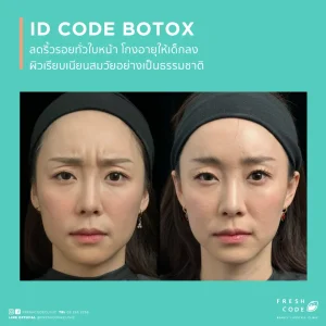 ผลลัพธ์ก่อนและหลังฉีด Botox เพื่อลดริ้วรอยและปรับกรอบหน้า Before after Botox สำหรับลดริ้วรอยหน้าผาก หว่างคิ้ว และหางตา ภาพก่อนและหลังฉีด Botox เพื่อให้ใบหน้าดูเรียบเนียนขึ้น Botox before after สำหรับลดริ้วรอยและทำให้กรอบหน้าดูคมขึ้น ผลลัพธ์ก่อนหลัง Botox สำหรับผู้ที่กังวลเรื่องริ้วรอยและรูปหน้า Botox before and after for smoother-looking skin and a more defined jawline Before and after Botox for forehead lines,frown lines,and crow’s feet Botox before and after results for facial lines and a softer appearance Before and after Botox for wrinkle reduction and facial contour refinement Botox before and after for a smoother,more refreshed look