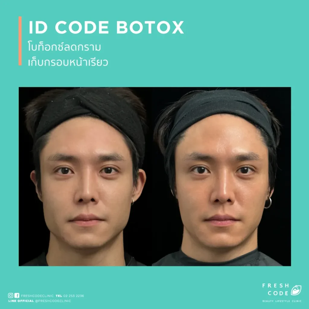 ผลลัพธ์ก่อนและหลังฉีด Botox เพื่อลดริ้วรอยและปรับกรอบหน้า Before after Botox สำหรับลดริ้วรอยหน้าผาก หว่างคิ้ว และหางตา ภาพก่อนและหลังฉีด Botox เพื่อให้ใบหน้าดูเรียบเนียนขึ้น Botox before after สำหรับลดริ้วรอยและทำให้กรอบหน้าดูคมขึ้น ผลลัพธ์ก่อนหลัง Botox สำหรับผู้ที่กังวลเรื่องริ้วรอยและรูปหน้า Botox before and after for smoother-looking skin and a more defined jawline Before and after Botox for forehead lines,frown lines,and crow’s feet Botox before and after results for facial lines and a softer appearance Before and after Botox for wrinkle reduction and facial contour refinement Botox before and after for a smoother,more refreshed look