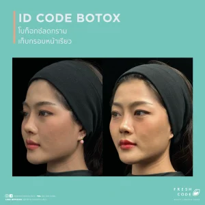 ผลลัพธ์ก่อนและหลังฉีด Botox เพื่อลดริ้วรอยและปรับกรอบหน้า Before after Botox สำหรับลดริ้วรอยหน้าผาก หว่างคิ้ว และหางตา ภาพก่อนและหลังฉีด Botox เพื่อให้ใบหน้าดูเรียบเนียนขึ้น Botox before after สำหรับลดริ้วรอยและทำให้กรอบหน้าดูคมขึ้น ผลลัพธ์ก่อนหลัง Botox สำหรับผู้ที่กังวลเรื่องริ้วรอยและรูปหน้า Botox before and after for smoother-looking skin and a more defined jawline Before and after Botox for forehead lines,frown lines,and crow’s feet Botox before and after results for facial lines and a softer appearance Before and after Botox for wrinkle reduction and facial contour refinement Botox before and after for a smoother,more refreshed look