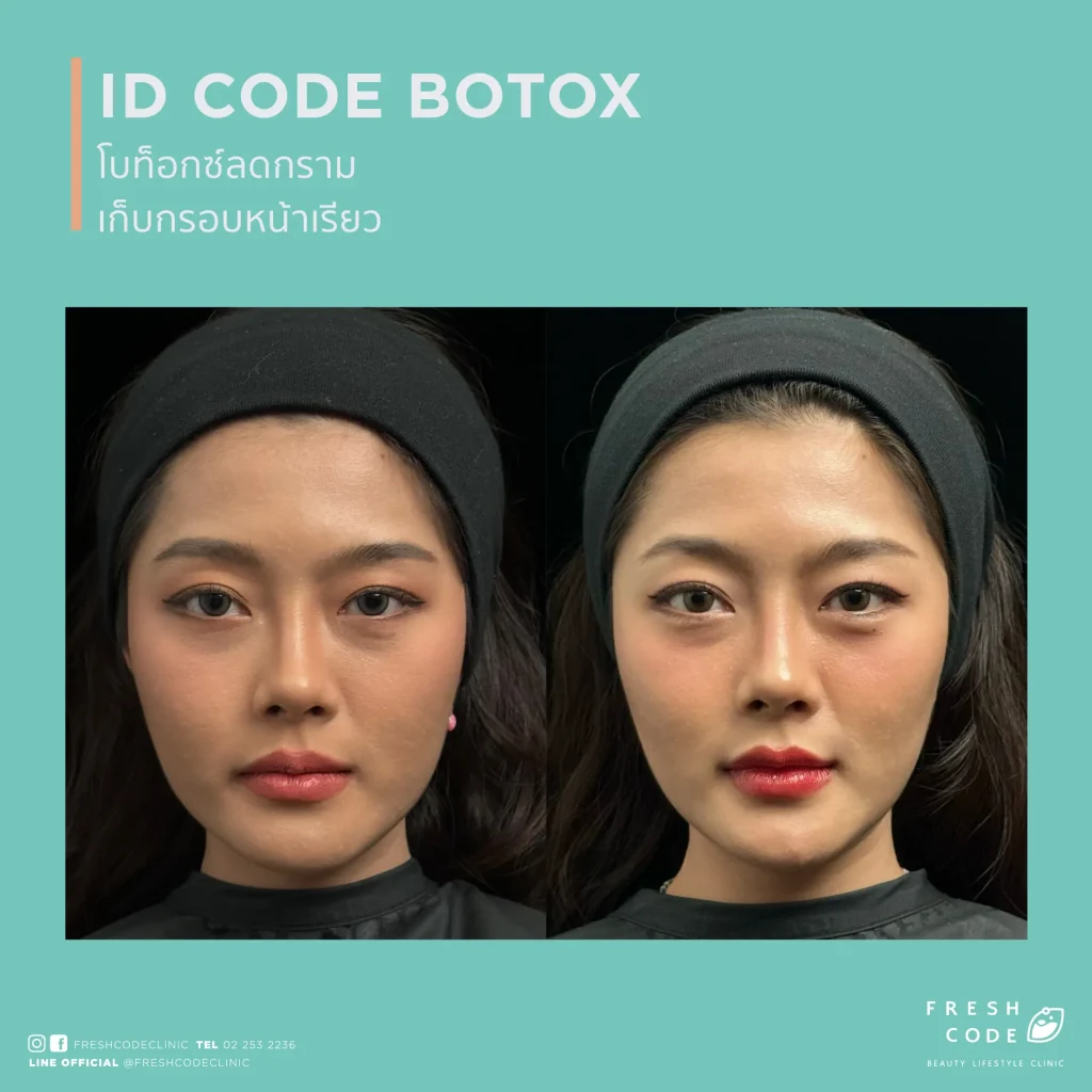 ผลลัพธ์ก่อนและหลังฉีด Botox เพื่อลดริ้วรอยและปรับกรอบหน้า Before after Botox สำหรับลดริ้วรอยหน้าผาก หว่างคิ้ว และหางตา ภาพก่อนและหลังฉีด Botox เพื่อให้ใบหน้าดูเรียบเนียนขึ้น Botox before after สำหรับลดริ้วรอยและทำให้กรอบหน้าดูคมขึ้น ผลลัพธ์ก่อนหลัง Botox สำหรับผู้ที่กังวลเรื่องริ้วรอยและรูปหน้า Botox before and after for smoother-looking skin and a more defined jawline Before and after Botox for forehead lines,frown lines,and crow’s feet Botox before and after results for facial lines and a softer appearance Before and after Botox for wrinkle reduction and facial contour refinement Botox before and after for a smoother,more refreshed look