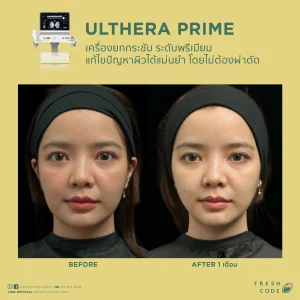 Ultherapy Prime before after รีวิวผลลัพธ์การยกกระชับกรอบหน้าและคิ้ว ด้วยเทคโนโลยี Microfocused Ultrasound ที่ Fresh Code Clinic