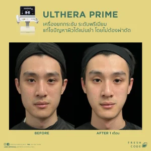 Ultherapy Prime before after รีวิวผลลัพธ์การยกกระชับกรอบหน้าและคิ้ว ด้วยเทคโนโลยี Microfocused Ultrasound ที่ Fresh Code Clinic