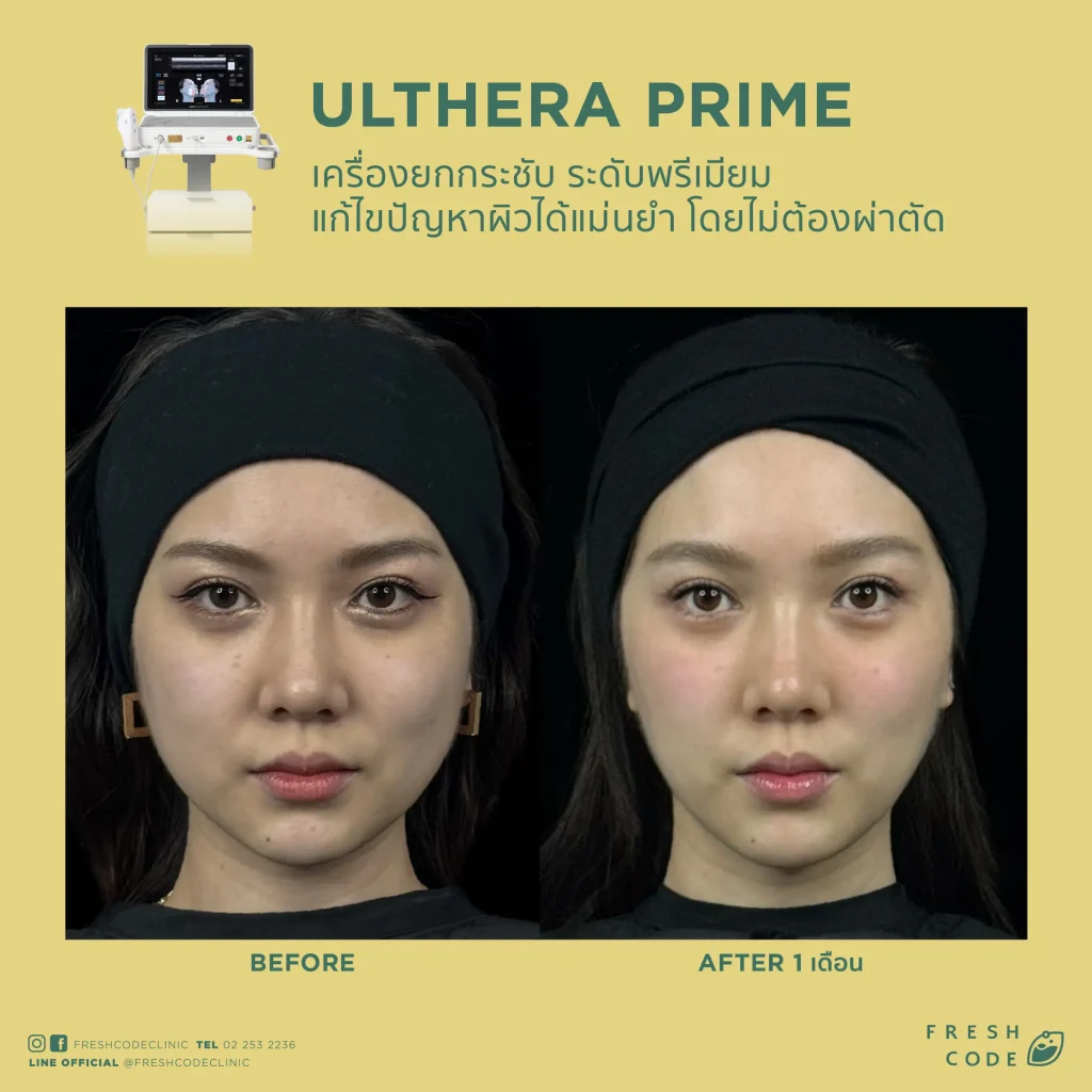 Ultherapy Prime before after รีวิวผลลัพธ์การยกกระชับกรอบหน้าและคิ้ว ด้วยเทคโนโลยี Microfocused Ultrasound ที่ Fresh Code Clinic