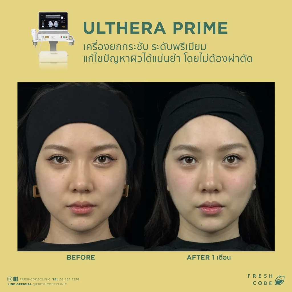 Ultherapy Prime before after รีวิวผลลัพธ์การยกกระชับกรอบหน้าและคิ้ว ด้วยเทคโนโลยี Microfocused Ultrasound ที่ Fresh Code Clinic