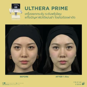 Ultherapy Prime before after รีวิวผลลัพธ์การยกกระชับกรอบหน้าและคิ้ว ด้วยเทคโนโลยี Microfocused Ultrasound ที่ Fresh Code Clinic