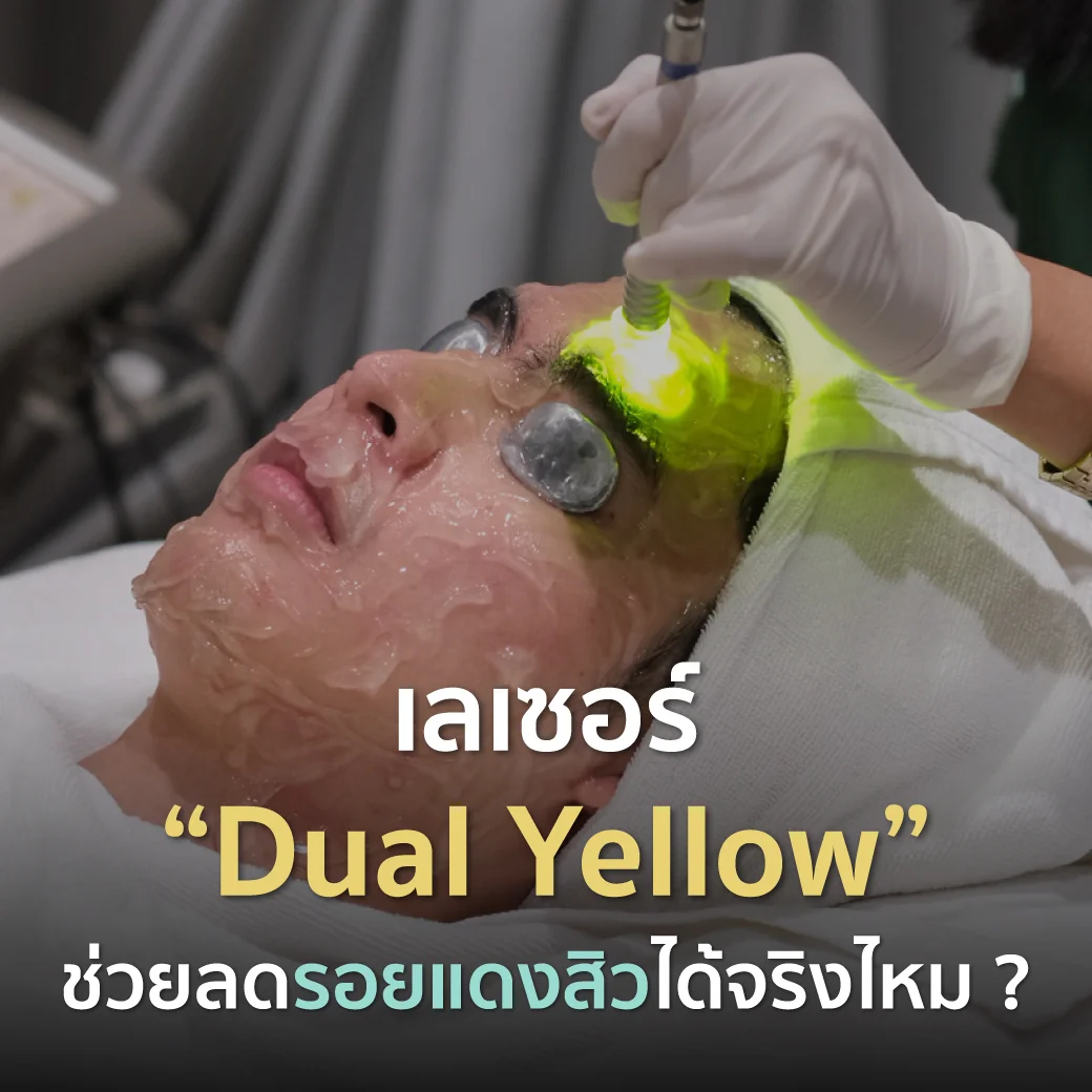 เลเซอร์ Dual Yellow ลดรอยแดงสิวและฟื้นฟูผิวหน้า ด้วยเลเซอร์รักษาสิวที่ Fresh Code Clinic